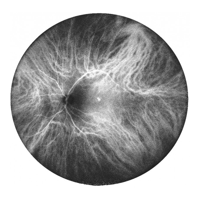 Lente Retina Staurenghi 230 SLO