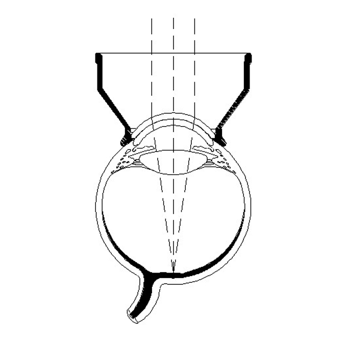 Lente per il miglioramento dell'immagine OCT Symons