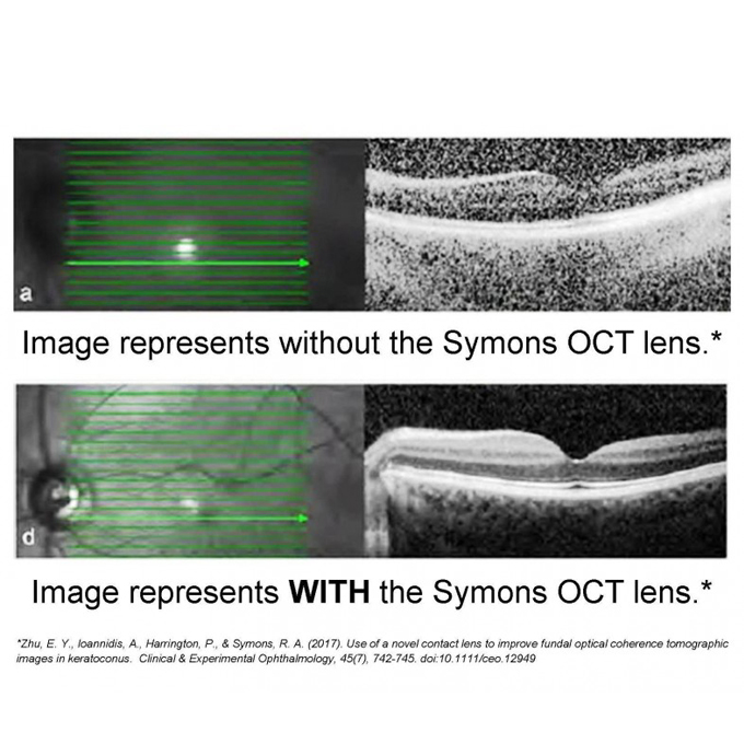 Lente per il miglioramento dell'immagine OCT Symons