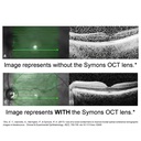 Lente per il miglioramento dell'immagine OCT Symons