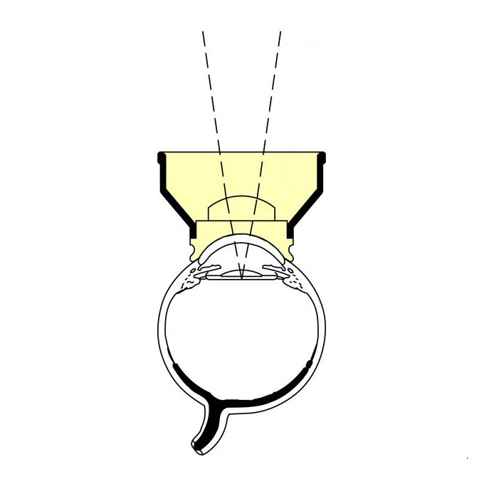 Lente Capsulotomia di Abraham
