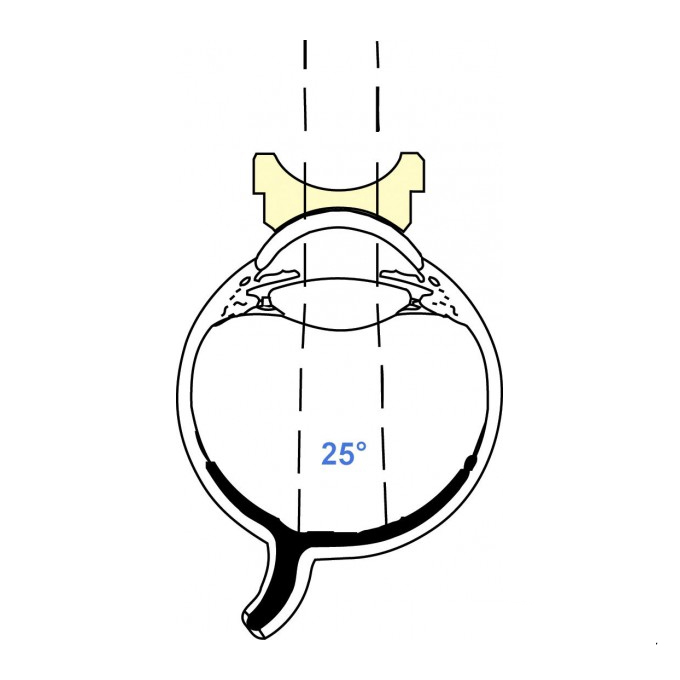 Lente di Landers Biconcava da 83D