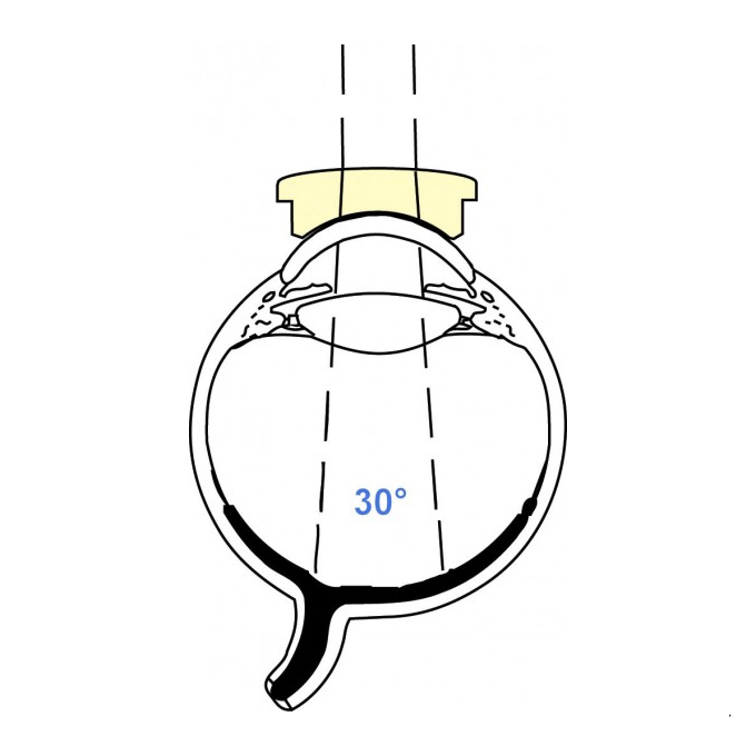 Lente di Machemer ingrandente