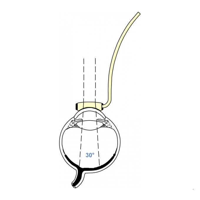Lente di Machemer ingrandente c/manico blu e infus.