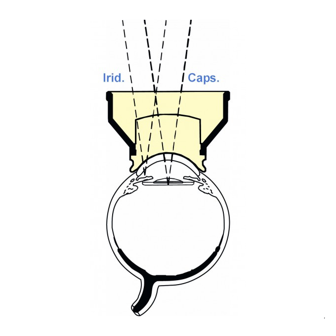 Lente di Mandelkorn Iridotomia e Capsulotomia