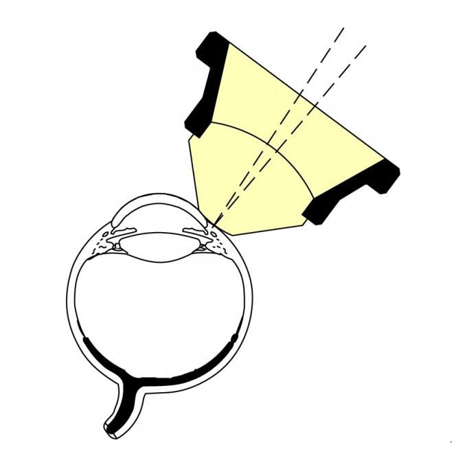 Lente di Mandelkorn per suture