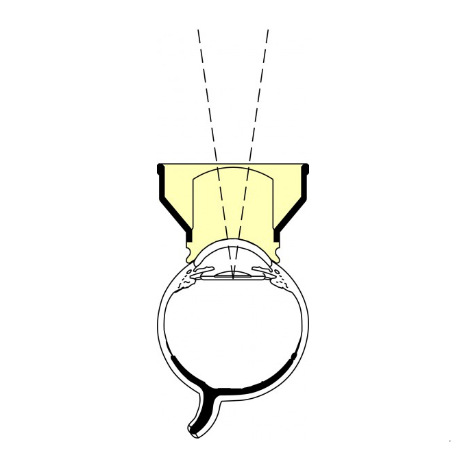 Lente di Peyman  per Capsulotomia