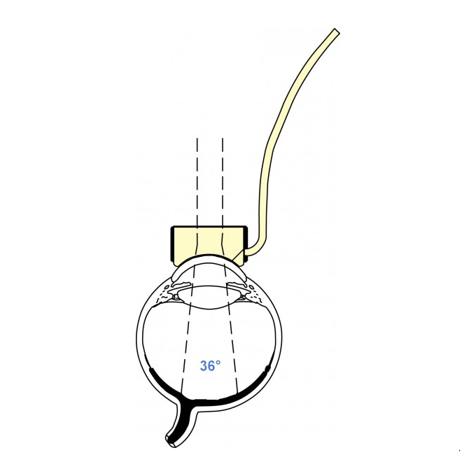 Lente di Peyman-Green c/manico verde e infusione