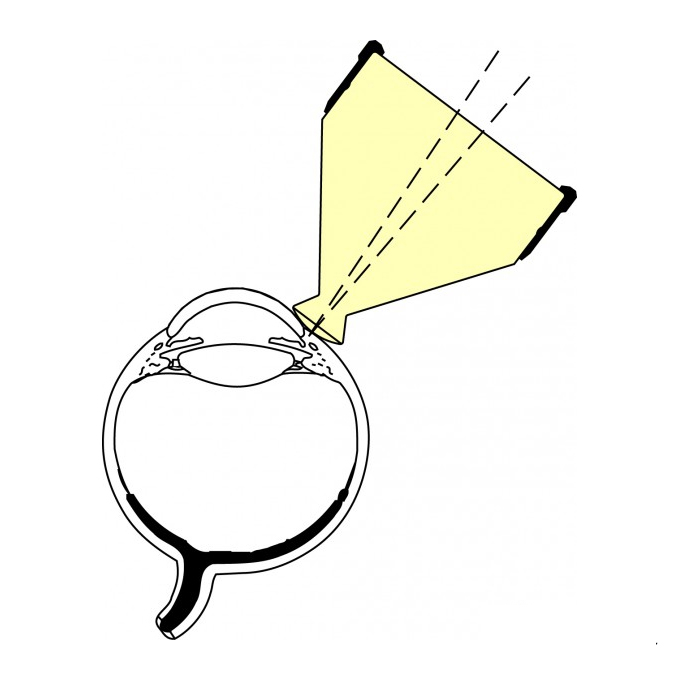 Lente di Ritch per suture nylon