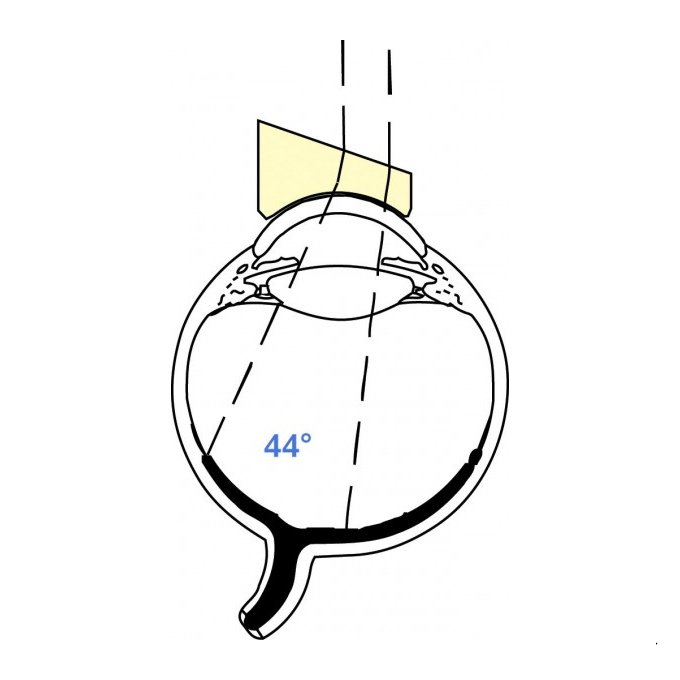 Lente di Tolentino prismatica 20° Alta risoluz.