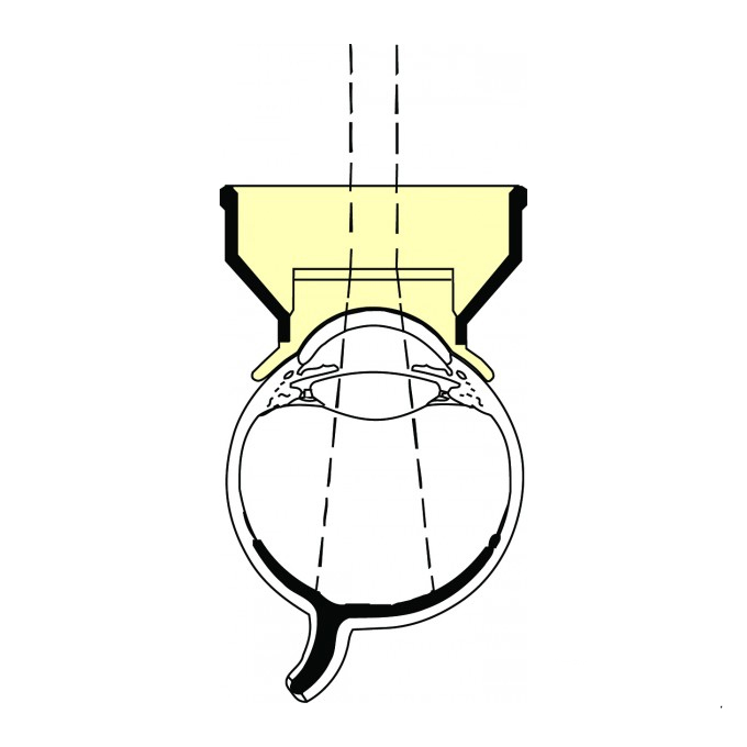 Lente di Yannuzzi per fondo