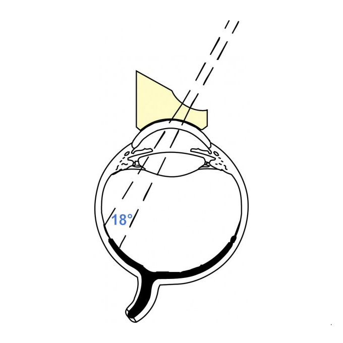 Lente prismatica di Woldoff biconcava