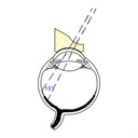 Lente prismatica di Woldoff biconcava